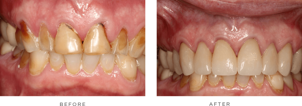case 5 before and after