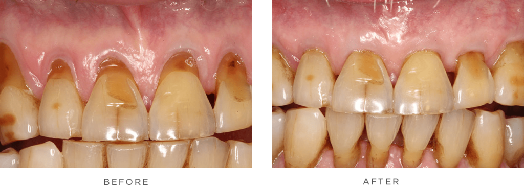 case 6 before and after