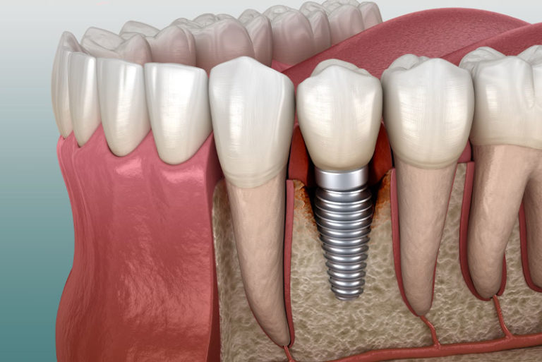 Peri-Implantitis Treatment | Ocala, FL | Crystal River, FL